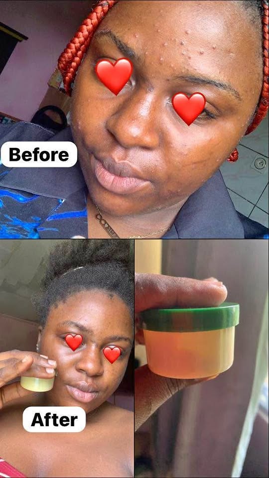 Pimples remedy / crème anti-acne